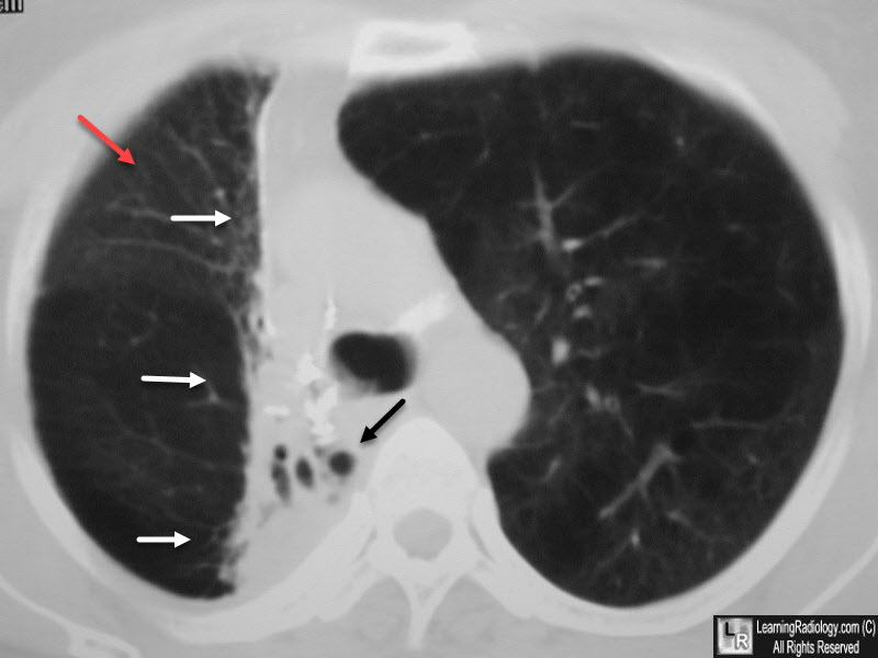 Radiation Fibrosis